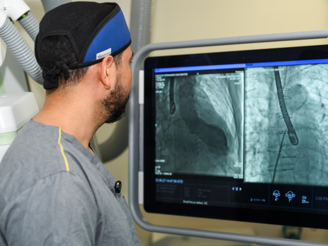 SUS de Sergipe faz dois procedimentos cardíacos inéditos: Impella emergencial e troca de válvula mitral por cateterismo